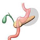 Sleeve-Resektion Magen