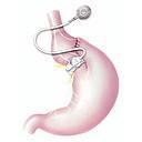 Verstellbares Magenband