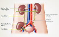Grafik zur Nierentransplantation