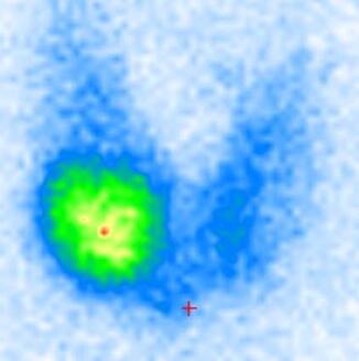 Schilddrüse - Heißer Knoten