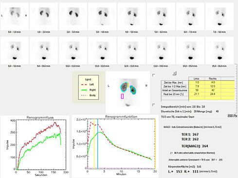 Normale Nierenfunktion mit normaler Ausscheidung: Die rechte Niere erbringt ca. 42 % und die linke Niere ca. 58 % der Gesamtfunktion