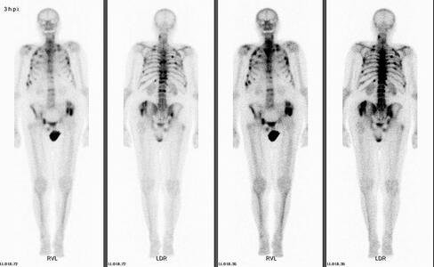 Multiple Knochenmetastasen