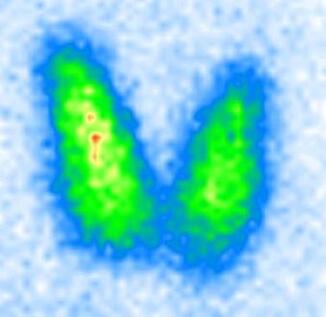 Schilddrüse - normaler Zustand