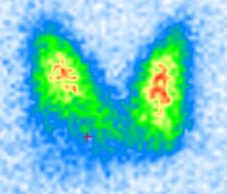 Schilddrüse - Kalter Knoten