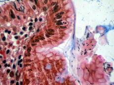 Magenschleimhaut entzündlich infiltriert, an der Oberfläche Bakterien (Helicobacter pylori).