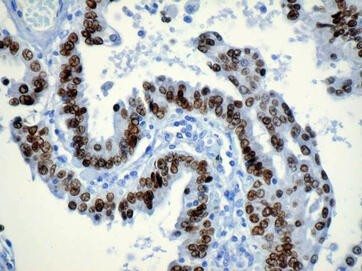 Histologie Adenocarcinom der Lunge immunhistochemisch markiert mit Antikörper TTF-1 (Zellkerne braun gefärbt)