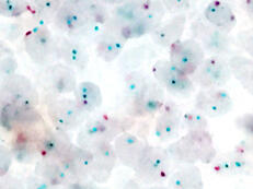 Chromogene-in-situ-Hybridisierung (CISH) zum molekularpathologischen Nachweis einer Überexpression des Gens ErbB2 (grüne Punkte) bei einem Mammakarzinom