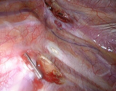 Abb 4: Clips zur Unterbrechung des Nerven oben und unten Nervenästchen in den Zwischenrippenräumen sind mittels Hochfrequenzstrom durchtrennt