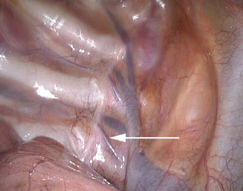 Abb 1: Blick auf den Grenzstrang (=Nervus sympathicus)