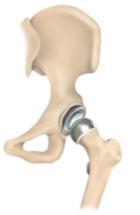 Hüftoberflächenersatzprothese