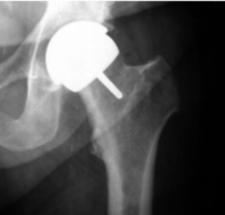 Hüftoberflächenersatzprothese im Röntgenbild