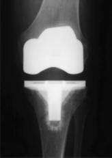 Knie-TEP im Röntgenbild