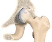 Künstliches Hüftgelenk