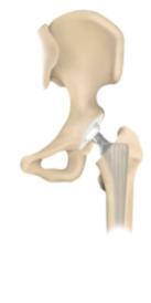 Zementfreie Hüftprothese