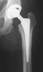 Zementfreie Hüftprothese im Röntgenbild