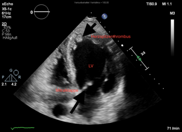 Apikaler Blick auf die linke Herzkammer mit hier offener Mitralklappe, als Besonderheit ist ein Thrombus in der Herzspitze zu sehen