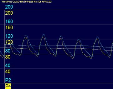 FFR-Wert 0,92, somit nicht signifikanter Unterschied der beiden Messkurven