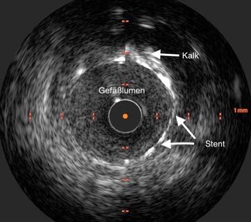 Intracoronarer Ultraschall bei verkalktem Gefäß nach Stentimplantation