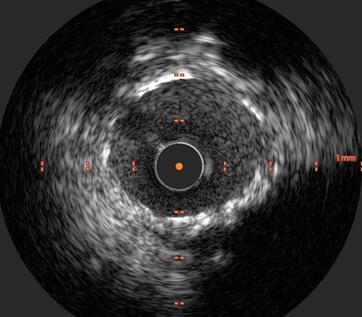 Intracoronarer Ultraschall bei verkalktem Gefäß nach Stentimplantation