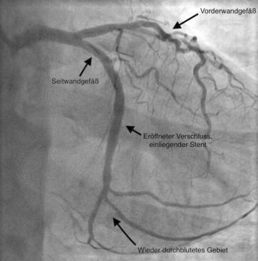 Wiedereröffnetes Seitwandgefäß nach Rekanalisierung und Stentimplantation
