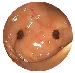 Diagnostische Endoskopie