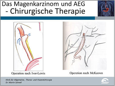 Abb.11: Darstellung der Operationsvarianten bei AEG-Tumoren Typ I (Erläuterungen siehe Text)