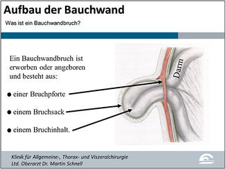Abb. 2: Aufbau einer Bauchwandhernie