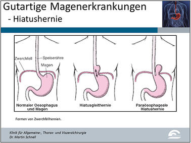 Abb.5: Darstellung von Zwerchfellbrüchen und deren Formen