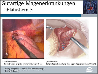 Abb.6: Darstellung einer Hiatushernie und schematische Darstellung deren operativen Behandlung