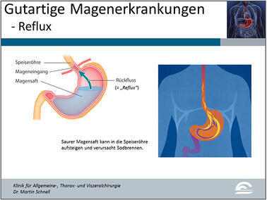 Abb.4: Darstellung der Entstehung von Sodbrennen