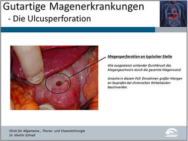 Abb.2: Bild einer Magenperforation