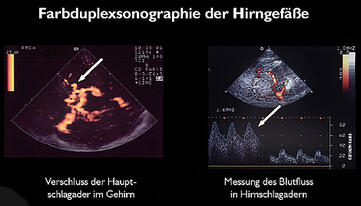 Farbduplexsonographie der Hirngefäße